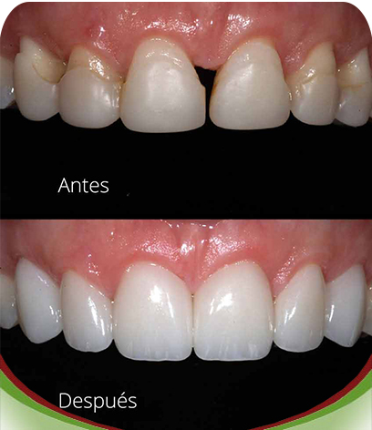 Estética Dental